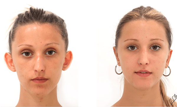 otoplastia-barcelona-dr-san-miguel-2